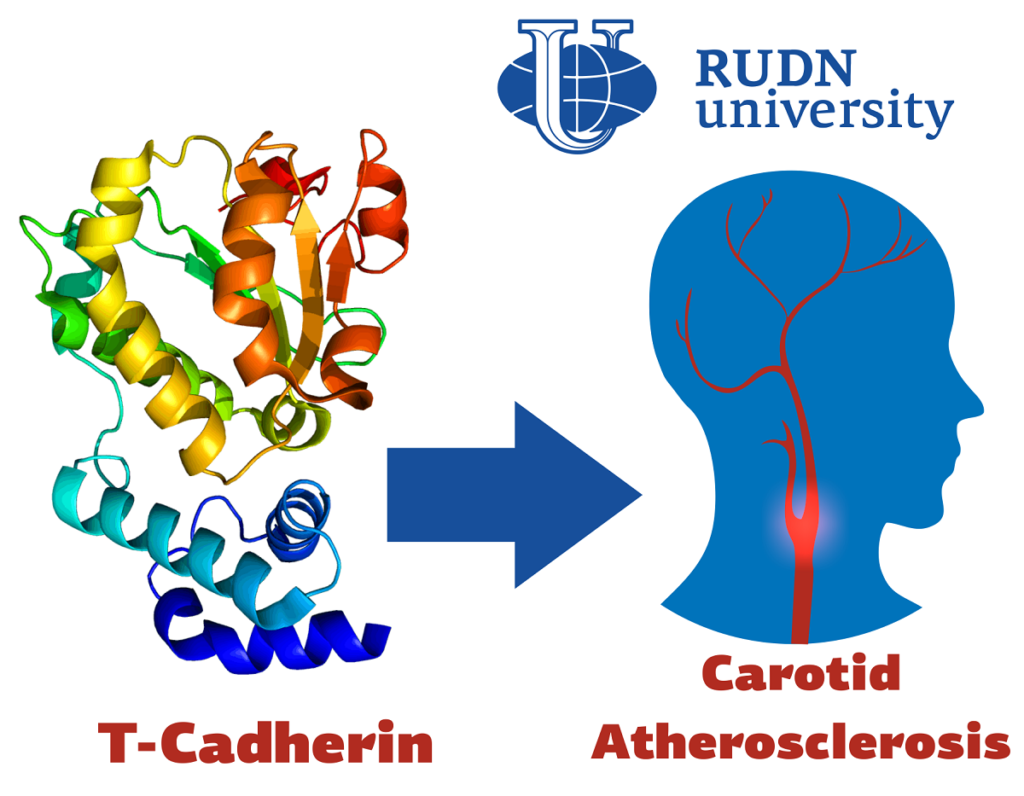 Медики РУДН впервые исследовали, как с развитием раннего атеросклероза связаны молекулы Т-кадгерины. Новые закономерности помогут диагностировать атеросклероз на ранней стадии